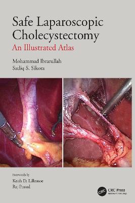 Safe Laparoscopic Cholecystectomy