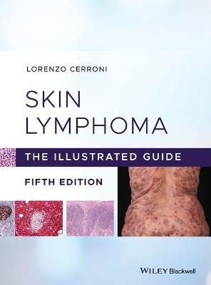 Skin Lymphoma