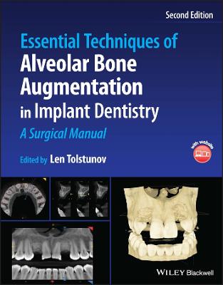 Essential Techniques of Alveolar Bone Augmentation in Implant Dentistry