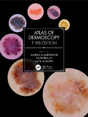 Atlas of Dermoscopy