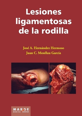 Lesiones ligamentosas de la rodilla