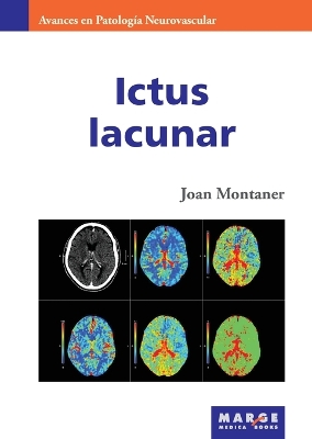 Ictus lacunar