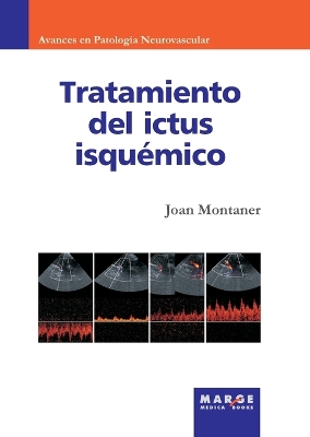 Tratamiento del ictus isqu?mico