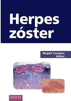 Herpes zoster