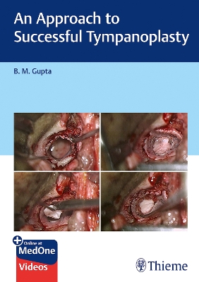 An An Approach to Successful Tympanoplasty